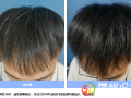 隨州市中心醫(yī)院：告別“禿”然焦慮 CGF讓秀發(fā)重生